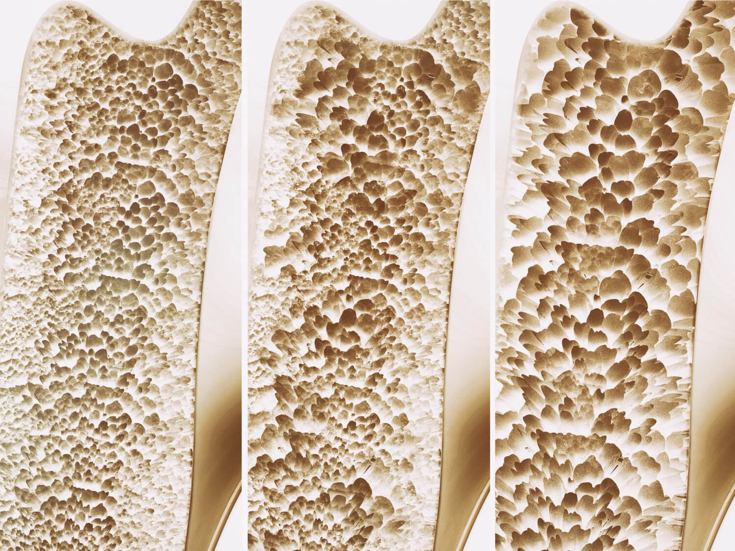 osteoporose