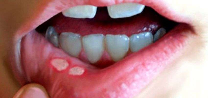 Behçet_lip